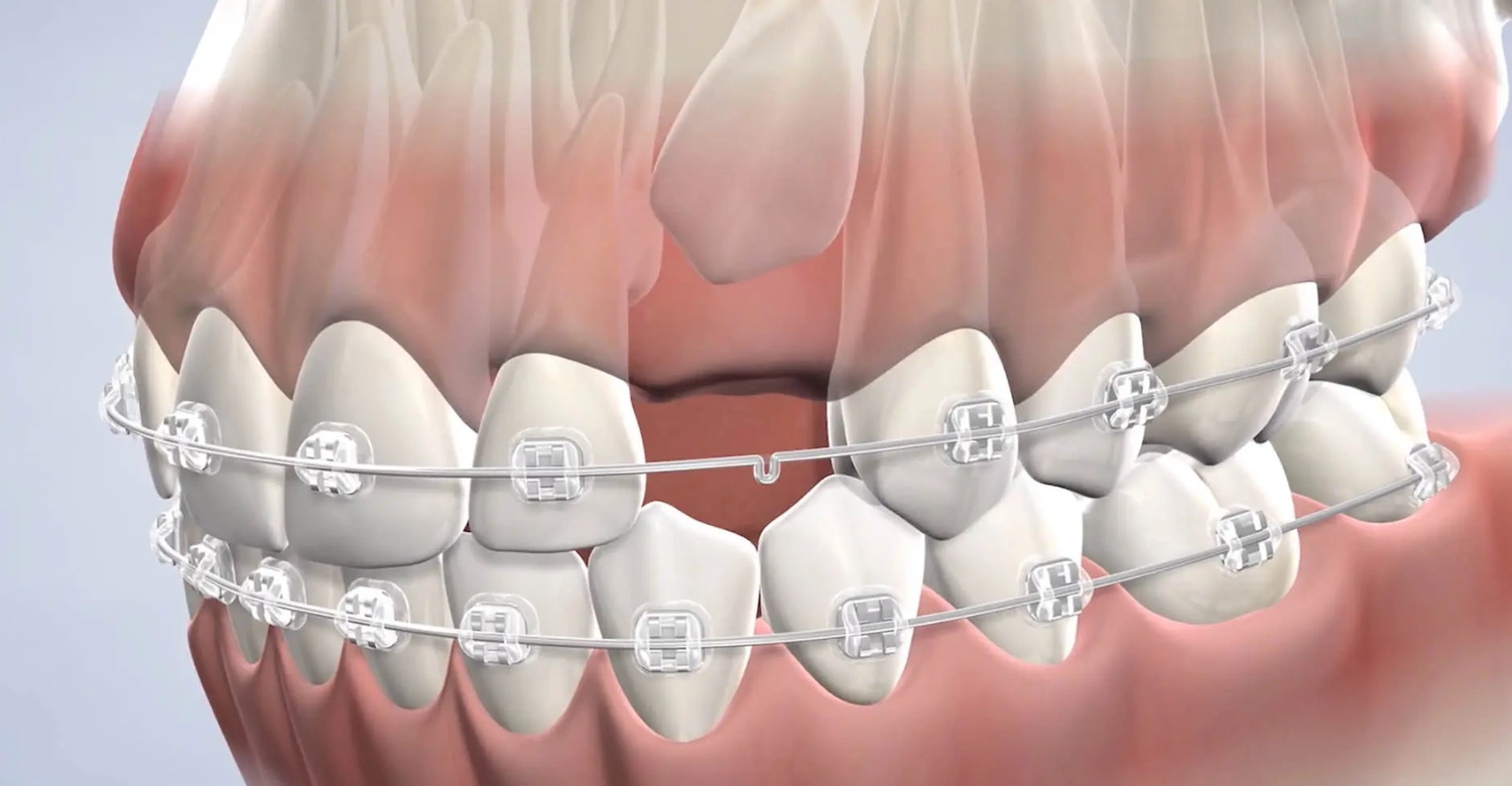 Impacted Canine Tooth inblog